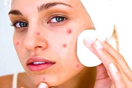 How to remove pimple marks from face fast at home