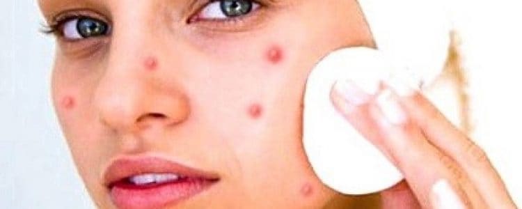 Top 5 Effective Tips For Managing Acne in 2021