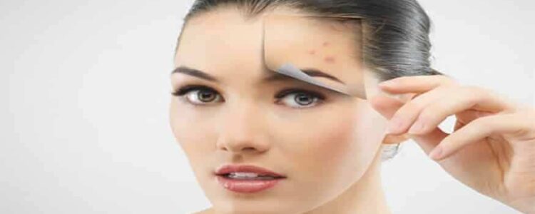 unveiling-the-most-stubborn-acne-scars-beautynbridal