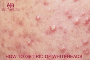 How to get rid of whiteheads