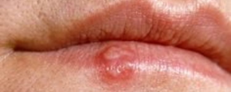 How to Get rid of Cold Sores