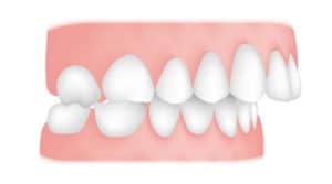 Misaligned Teeth