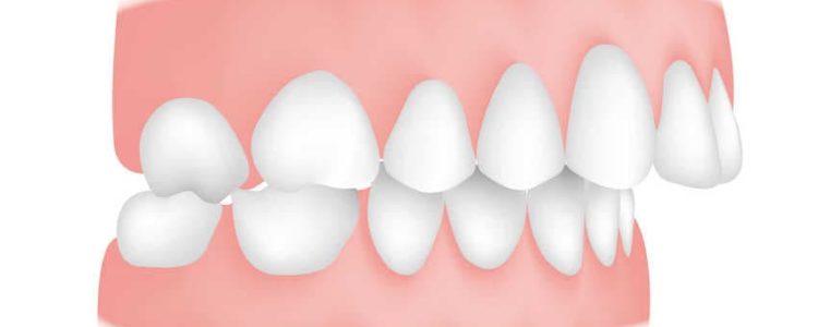 Causes of Misaligned Teeth and Treatment Options to Consider