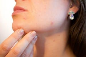 Types of acne