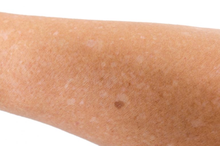 white-spots-on-skin-treatment-and-vitiligo-causes-and-vitiligo-symptoms